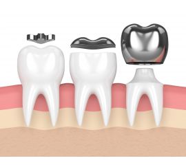Пломбировочные материалы